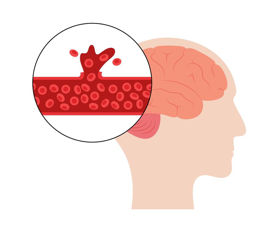 Brain Injury